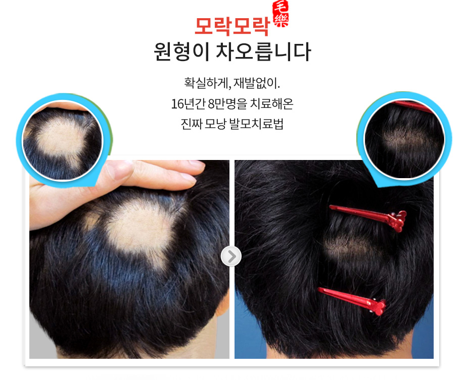 모락모락 원형이 차오릅니다. 확실하게, 재발없이. 16년간 8만명을 치료해온 진짜 모낭 발모치료법