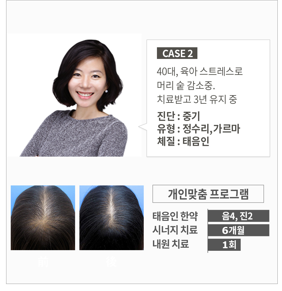 40대, 육아 스트레스로 머리 숱 감소중. 치료받고 3년 유지 중