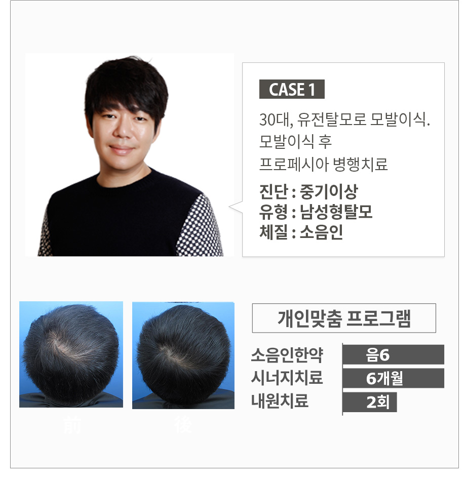 30대, 유전탈모로 모발이식. 모발이식 후 프로페시아 병행치료