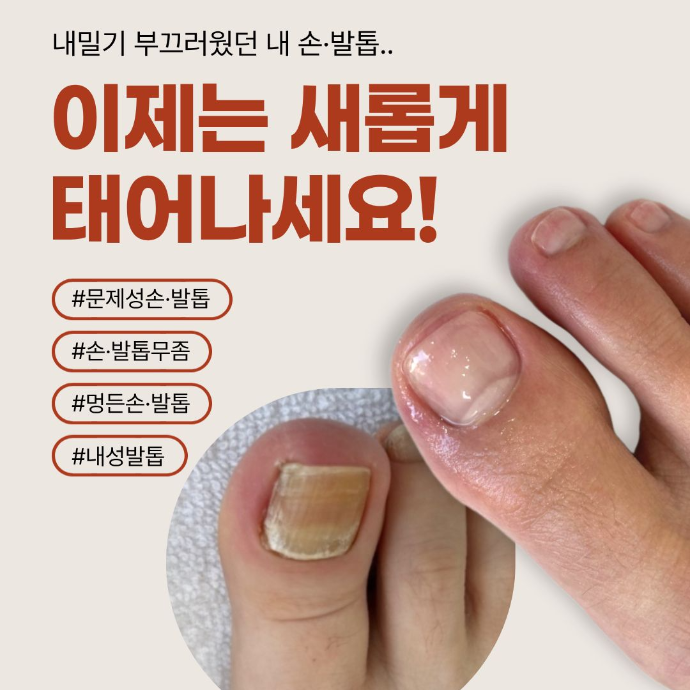 [등촌동] 김수정뷰티 가양역점 문제성 손/발톱 케어 체험단 모집